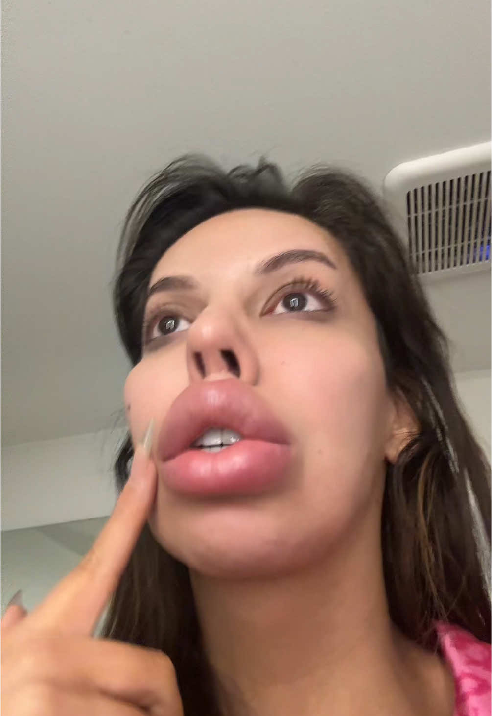 Serious question … Am I the only one who’s lip filler swells when there sick ? #viral #fyp #foryoupage #trending #lipfiller #filler 