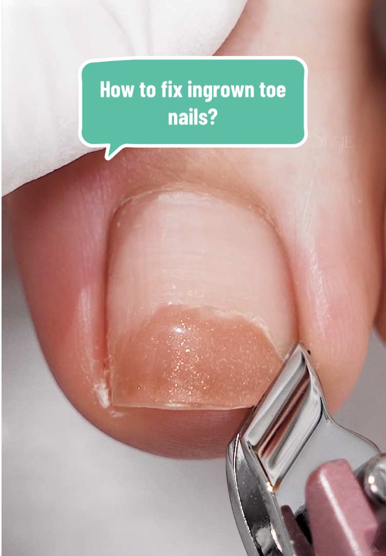 How to fix ingrown toenails? Quick file nails using SC320F Nail Drill and sanding bands! #TikTokShopRestock #melodysusie #melodysusienails #nailtools #nailart #nailchallenge #nailtutorial #nailtechlife #nailtechcheck #nailtechproblems #nailtechnician #nails #nailbeginner #nailpro #naillover #nailhack #nailtips #nailtip #naildrill #toenail #nailtok #nailsoftiktok 