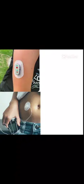 #diabetes #dt1 #diabetestype1 #fyp #foryou #foryoupagе #viral #xybca #trend 