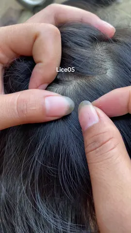 😱😱😱#omg #lice #liceremoval #treanding 