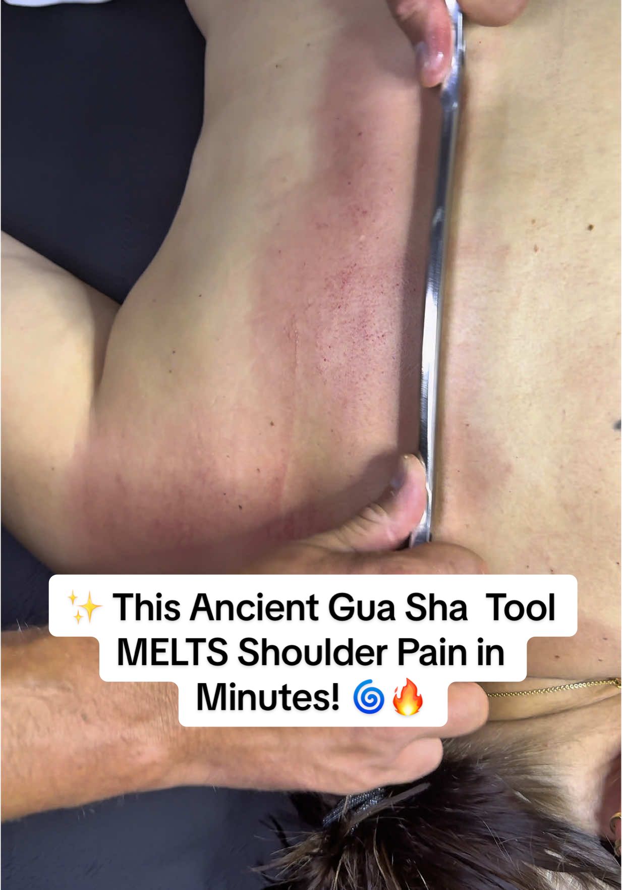your shoulders feel tight, stuck, or full of tension—this is the therapy your body has been begging for. 😩💥 Used for centuries in Traditional Chinese Medicine, Gōsha (Gua Sha) helps break up deep muscle tension, clear inflammation, and restore healthy blood flow—naturally. 🌿💆‍♂️ Just 5 minutes of scraping magic along key meridians and muscle groups can: ✅ Relieve frozen shoulder ✅ Improve mobility ✅ Release trapped fascia ✅ Eliminate stubborn knots It’s not just scraping—it’s deep healing. No meds. No injections. Just the power of pressure, energy flow, and ancient hands-on wisdom. ✨👐 Try Guasha once… and feel lighter, looser, and pain-free. 🚀💚 🔥 #guasha #guashatutorial #scraping  #ShoulderPainRelief 🦾 #GoshaHealingTool 🌀 #AncientScrapingTechnique 🎋 #FrozenShoulderFix ❄️ #MuscleReleaseMagic ✨ #TraditionalHealing 🌿 #GuaShaTherapy 💆‍♂️ #PainFreeShoulders ⚡ #MeridianMassage 🌱 #TensionGone 💥 #FunctionalRelief 🛠️ #KinesiologyAndGuaSha 🧠 #EnergyFlowTherapy 🌊