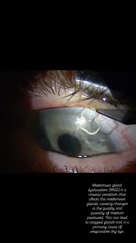 It was a great day for saving dry eyes 👀  This patient presented in clinic today for a booster IPL and LLLT, and was also complaining about a sore and tender lid and little clogged glands they could see in the mirror along their lid margin.  After their treatment today, this was just one of the many videos of the expression from this Meibomian gland. It felt like it was never ending.  So glad @paiging_drharvey go to experience it with me today 😜 #optometrist #optometry #meibomianglanddysfunction #dryeye #dryeyesyndrome 