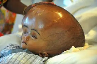 Please, let’s stop mocking or whispering about babies with unusually large heads. What you’re seeing might be hydrocephalus, a serious medical condition. Hydrocephalus means there's too much fluid in the brain. This fluid is called cerebrospinal fluid (CSF), and it's supposed to protect the brain and spinal cord. But when it builds up too much, it causes the baby’s head to swell because their skull bones haven’t fused yet. Causes include: Brain infections like meningitis Bleeding in the brain Birth defects Sometimes, the exact cause isn’t known How can you recognize it early? Rapid head growth Bulging soft spot (fontanelle) Vomiting or poor feeding Sleepiness or irritability Eyes that look “sunset” (turned downward) Can it be treated? Yes, with surgery. Doctors often insert a shunt (a thin tube) to drain the excess fluid from the brain to another part of the body. Early diagnosis and treatment can save the baby’s brain and future. Always stand up for every child born different pls. Their lives matter too. Credit: Student Nurses & Midwives – Health Care Champions #HydrocephalusAwareness #ChildHealth #PediatricCare #NoToStigma #EarlyInterventionSavesLives #childcare #lylahhealthyvibe 