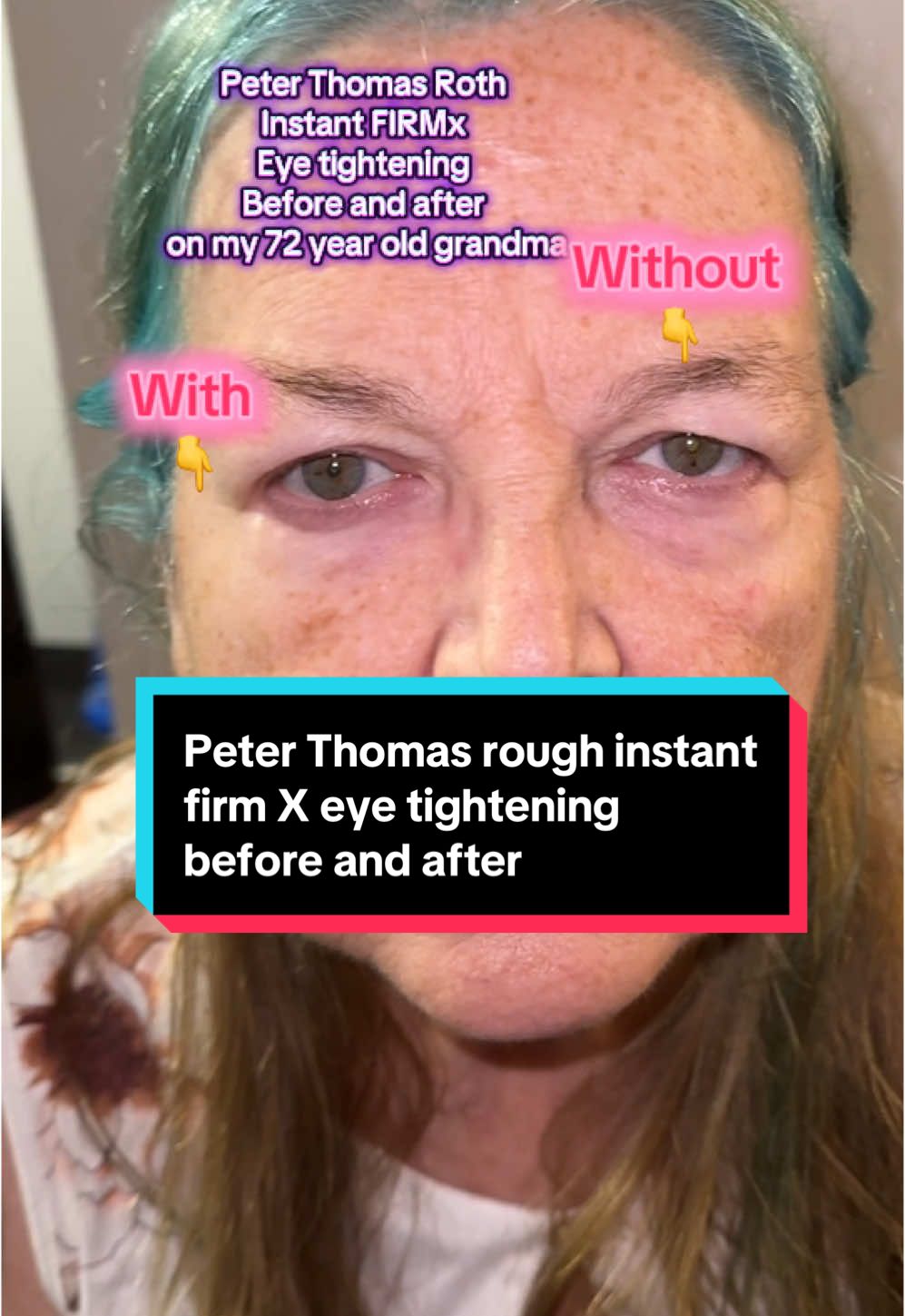 @Peter Thomas Roth Labs 🥰 #ptrbeforeafter #tiktokshoprestock Star : @Gloria Dean 🥰  A great representation of the Peter Thomas Roth instant firmx eye tightener !  #peterthomasroth #instantfirmx #eyetightener #undereyebags #beforeandafter #beauty #matureskin 