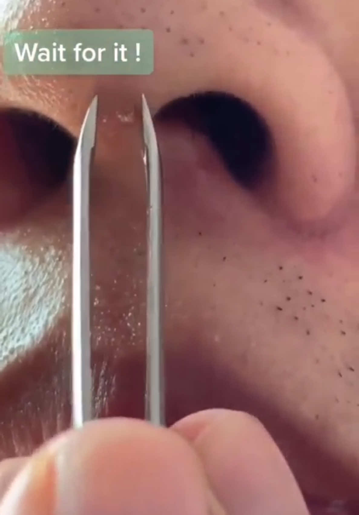 I sneezed watching this! ⚠️ 🫶🏽 - Unknown creator (please tag if known and I will update accordingly) 🙏🏽 - #foryoupagе #pimples #satisfyingvideos #pimplepop #ingrownhair #nose #fyp 