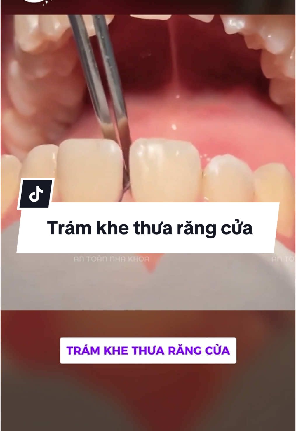 Trám khe thưa răng cửa. #LearnOnTikTok #antoannhakhoa #rang #saurang 
