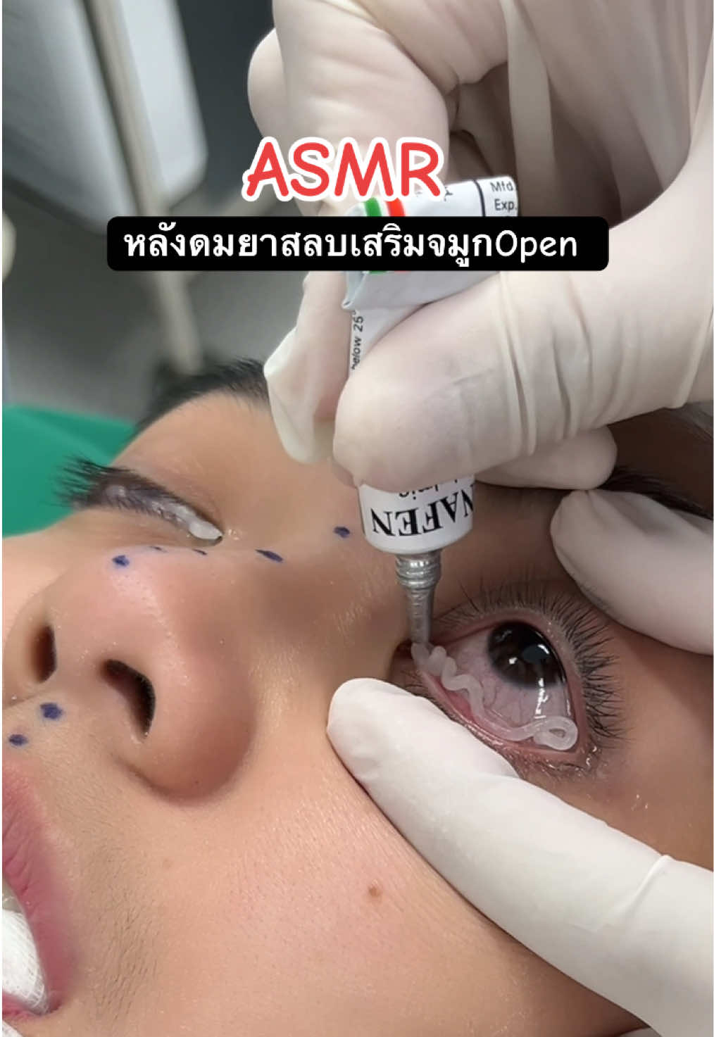 ASMR หลังดมยา เสริมจมูกOpen #asmr #asmrvideo #asmrsounds #asmrtiktoks #เสริมจมูก #แก้จมูก #สวยพุ่งจนต้องแชร์ #เพลงฮิตtiktok #เลอนิสต้าคลินิก 