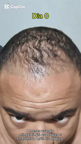 Bizu! #finasterida #minoxidil #finasteride #crescimentocapilar #calvicie #alopeciaandrogenetica #cabelos #calviciemasculina #calvos #tratamentocapilar 
