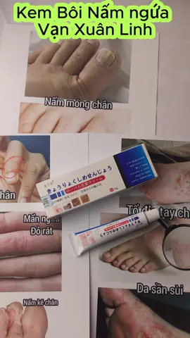 Kem bôi nấm ngứa Vạn Xuân Linh hỗ trợ mọi vấn đề về ngứa da