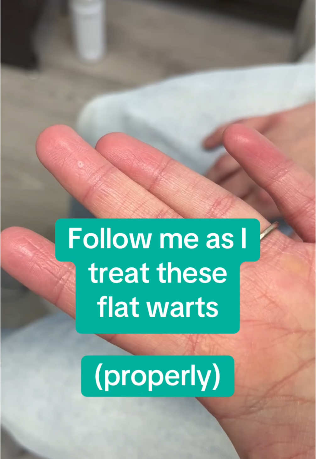 Here’s how to treat flat warts (properly) 😉 #fellowship #dermatologist #dermatology #warts #skincare #nitrogen #moreyouknow 
