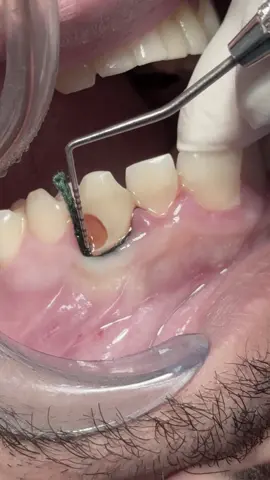 Class V composite restoration #dentist #dental #dentistry 