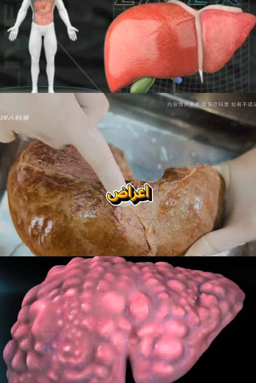 كبدك يحتاج إلى هذا الشاي!🍵🍃 #liver #liverdisease #fyp #detox #الكبد #الكبد_الدهني #hair #fart #liverhealth #detoxtea #liverdetox #التخلص_من_الكرش #wellnesstips #التخلص #fattyliver #healthytips #detoxtea #healthdrink #detoxdrink 
