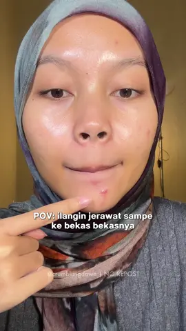 multifungsi woii jd bisa kempesin jerawat sekaligus pudarin bekasnya 😭🫰🏻🫰🏻🫰🏻 #acnespot #obattotoljerawat #youacnespot #skincare #jerawat 
