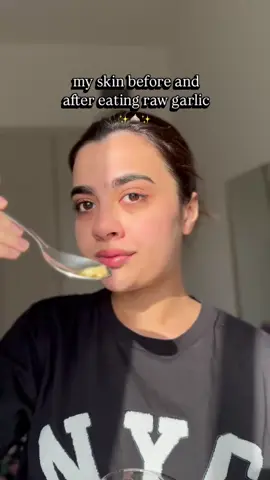 Here are the results! I ate raw sliced garlic with honey everyday for 7 days and after that I ate it once or twice a week. Just slice the garlic and let it sit in honey for 5-10 mins before eating it. #garlic #cleanskin #homeremedies #garlichoney #koreanskincare 