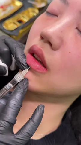 Quá trình tiêm môi siêu nét. Môi xinh Hải Phòng#tiktoklive #livehig #moixinhhaiphong #xuhuongtiktok #CapCut #xuhuongtiktok2024 #xuhuong 