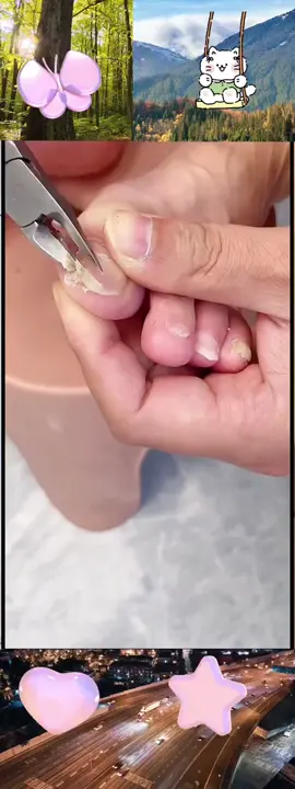 ¡Dile adiós a las uñas encarnadas y gruesas! Este cortaúñas de apertura ancha corta sin esfuerzo incluso las uñas más duras, con precisión y sin ensuciar gracias a su sistema de recolección automática. ¡Imprescindible para un cuidado perfecto de las uñas! 👣✂#CortaUñasDeAperturaAncha #SoluciónParaUñasEncarnadas #CortadorDeUñasGruesas #CuidadoDeUñasFácil #EsencialesDeHigiene #HerramientaImprescindible #CortePreciso #SinDesorden #FácilDeUsar #MejorCompra #TendenciaEnTikTok #ProductoViral #compraahora