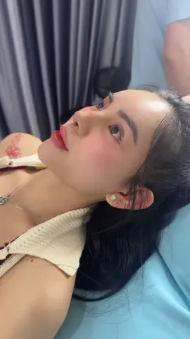 Dáng mũi trung hoa 5ngày tuổi 👃 #taohinhdouyin #muitrunghoa #xuhuong #nâng_mũi_cấu_trúc_đa_tầng #jline 