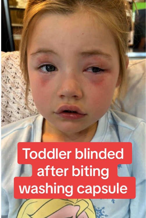 Toddler blinded after biting washing capsule #dailymirror #news 