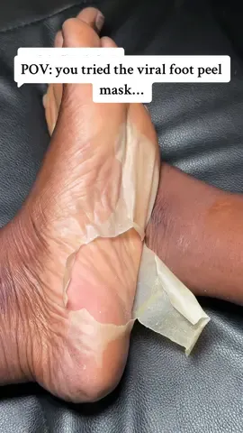 Replying to @TheJenniferInTransit Day 10: The dramatic peel has started! Skin underneath is so soft 🥰🥰 I tried the viral foot peel mask 10 days ago & it has finally started peeling off for me! It is so satisfying & the skin underneath is sooooo SOFT 😍🥰 #foot #footpeel #footpeelingmask #footpeelmask #footpeeling #SelfCare #selfcaretips #skincare #reviews #footcare #footcallusremoval #spotlight #spotlightfinds #tiktokmademebuyit #dealdrop #dealdrops #vairal #tiktokshopmademebuyit #blowup 