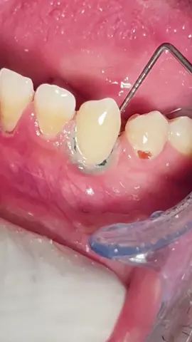 Composite restoration class V #dentist #dental #dentistry #طبيب_اسنان 