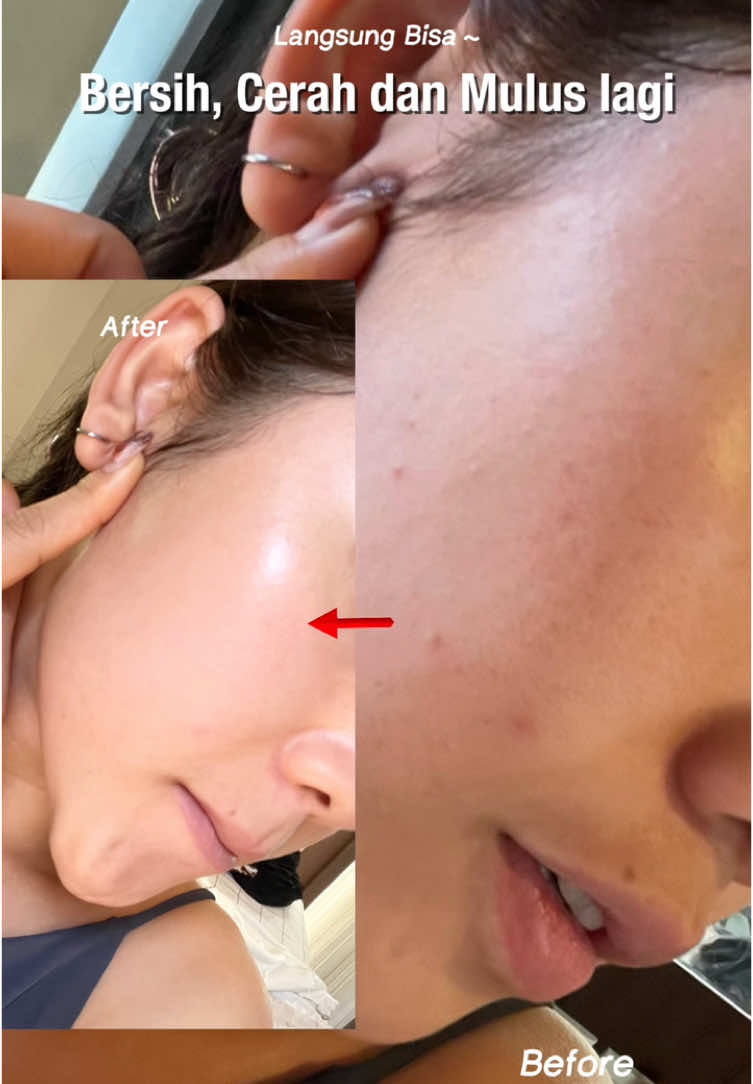 bisa mulus bersih dari masalah kulit yang kusam kasar dari pembersihan (Double Cleansing) yang bener. Step yang paling penting kalo mau kulit ga gampang breakout gara-gara minyak/kotoran yang nyangkut dan bikin penyumbatan di pori-pori dan bikin masalah kulit. Pentingnya cari 'Cleanser' yang bagusss juga apalagi kalo ada Infuse Exfoliator kaya ini Bubble Cleanser, yang bisa bersihin total ga cuma bagian kulit luar aja, patut dan WORTH IT untuk dicoba👍🏻 #Solusiskincare #Kulitkasar #Kusam #Breakout #Skintexture #Doublecleanser 
