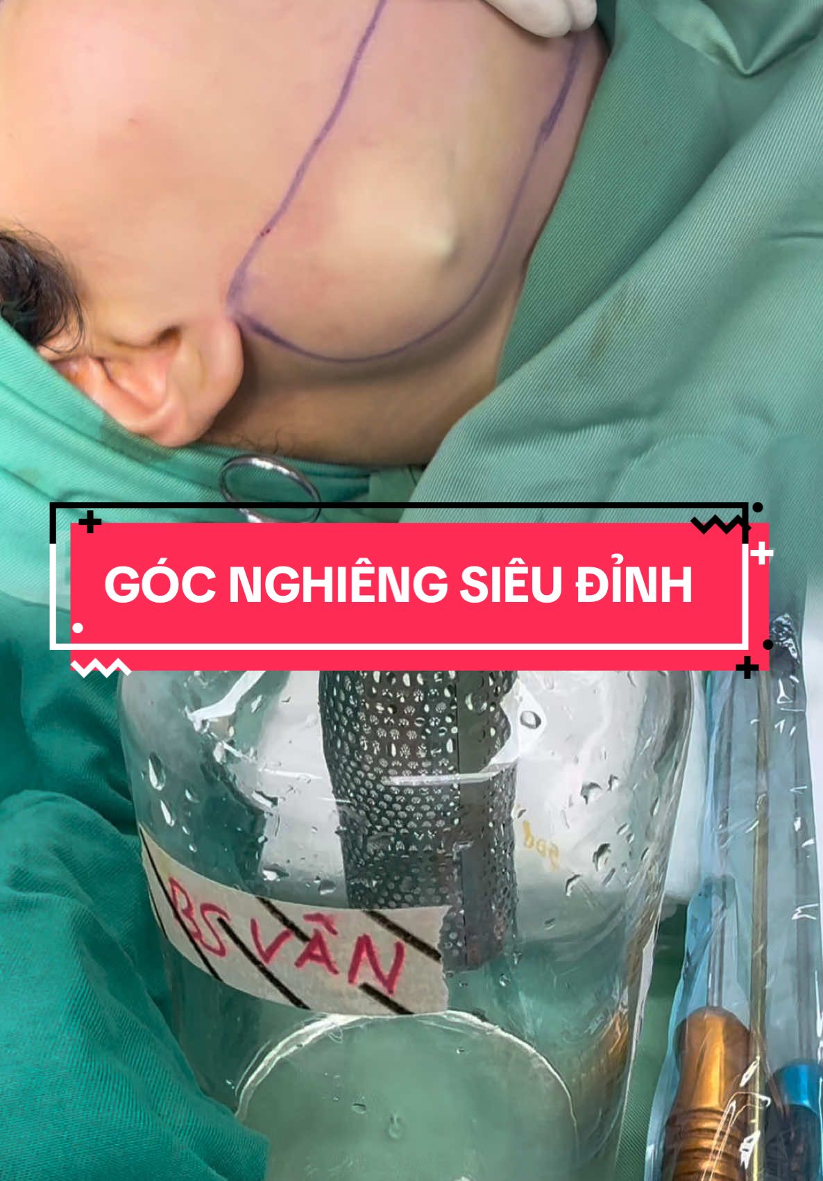 Dọn mỡ đi chơi Lễ #bacsivanthammy #hutmo #hutmoma #hutma #laytuimoma #hutmomangoai #hutmonongcam #hutmonong #hutnong #hutmat #thongonmat #hutmotoanthan 