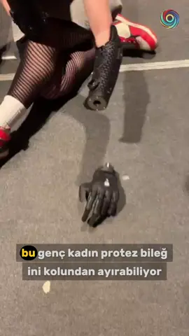 Gelişmiş bir protez teknolojisi sayesinde, bu genç kadın elini kolundan tamamen ayırsa bile uzaktan kontrol edebiliyor. Koluna yerleştirilen sensörler, kas hareketlerini algılayarak sinyalleri kablosuz olarak ayrılmış protez ele iletiyor. Böylece günlük hareketler, hatta tokalaşmak gibi sosyal etkileşimler bile vücuttan bağımsız şekilde gerçekleştirilebiliyor. Bu yenilikçi sistem, protez kullanımında çığır açan bir adım olarak görülüyor.