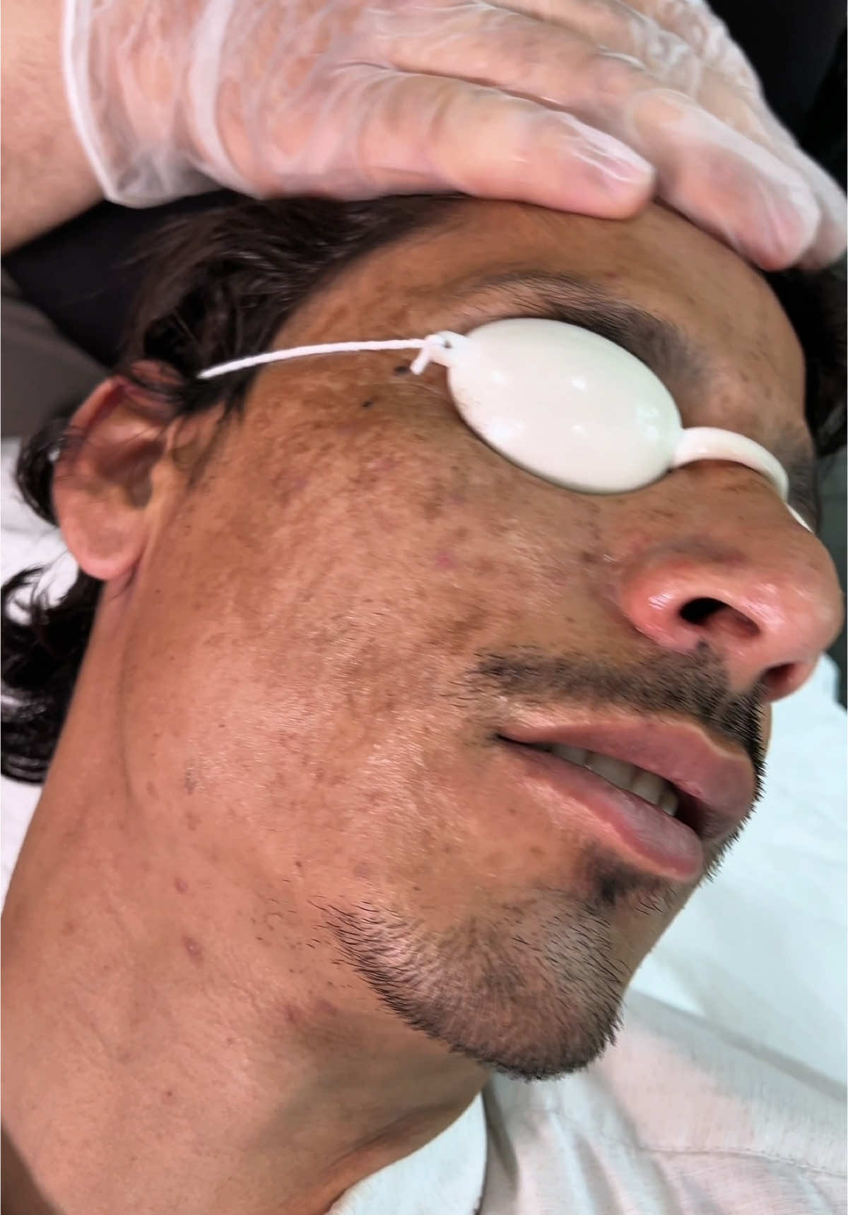 Pico laser for Melasma##tranding #skincareroutine #skin#drsanaullah05 #faceglow #typ #fyp #fyp #fyp*y #drsanaullah05 #viralvideo