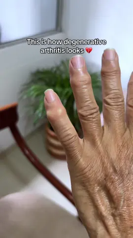 Why didn’t I know this before?!😭❤️‍🩹🦾 #arthritis #arthritisrelief #jointpain #physiotherapy #physicaltherapy  This rehabilitation training device is helping my mom to recover flexibility and movement in her hands, also is helping her with joint pain and inflammation. It’s helping her regain flexibility in her fingers and works as an at-home therapy that complements her medical treatments for arthritis or degenerative osteoarthritis. Degenerative osteoarthritis is a chronic joint disease that wears down cartilage over time, affecting bones and surrounding tissues. It causes pain, stiffness and reduced mobility in the joints 