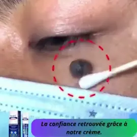 ✅Achetez notre crème Anti-verrue avec la LIVRAISON GRATUITE 