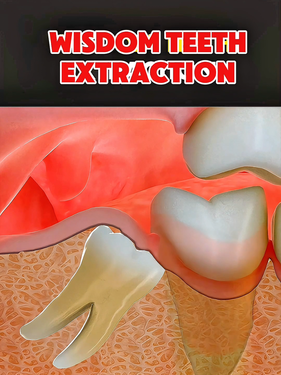 Wisdom Teeth Extraction Educational 3D animation for public awareness and health professionals.  #WisdomTeethRemoval #WisdomTeethExtraction #DentalSurgery #ToothExtraction #OralSurgery #WisdomTeethProblems #DentalCare #WisdomTeethRecovery #ToothRemoval #DentalHealth  #healthcare #medical #surgery #fyp #viral 