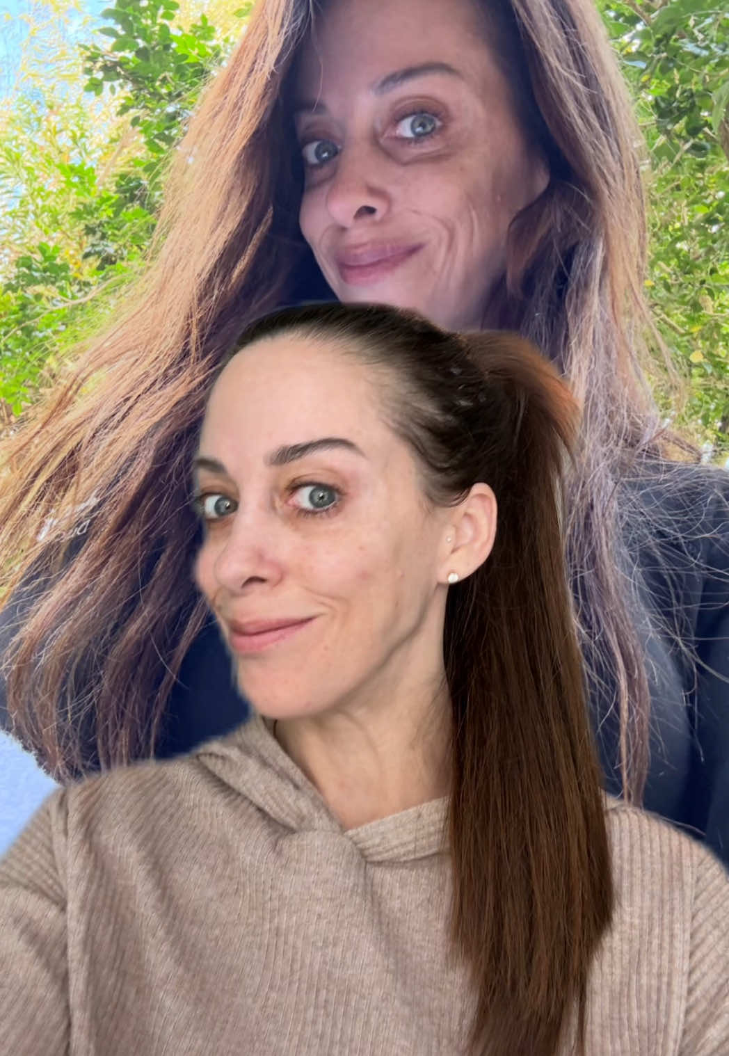 Volufiline results! #volufiline #skincare #skin #wrinkles #filler #threads #botox #threads #pdothreads #tiktokmademebuyit #skincaretiktok #glowingskin #beforeandafter #antiaging #skincarereview  