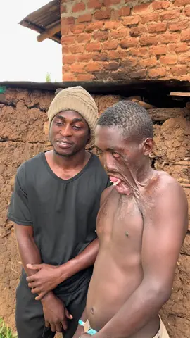 Help benard get surgery #hungryhunger #surgery #skinsurgery #benard #burnt #usa #hunger #germany #australia 