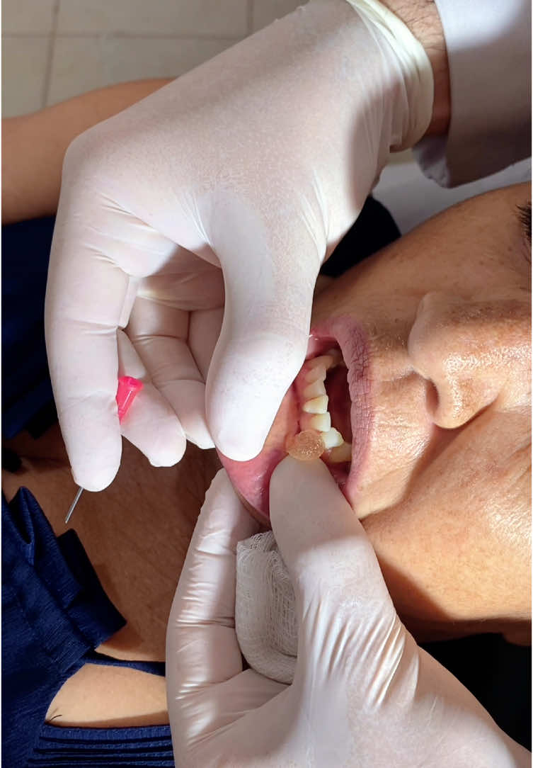 Remoção de preenchedor (excesso) #satisfatório #dermatologia #lábios #lips #prenchimentoboca #satisfy #hialuronico 