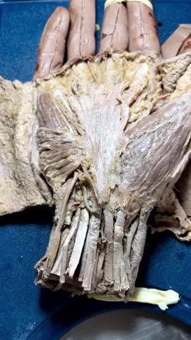 ✅ Inervação do músculo palmar curto _ #anatomia #disseccao #aponeurosepalmar  #dissecacao #palmarcurto  #nervoulnar  #ensinoanatomia #learninganatomy #science
