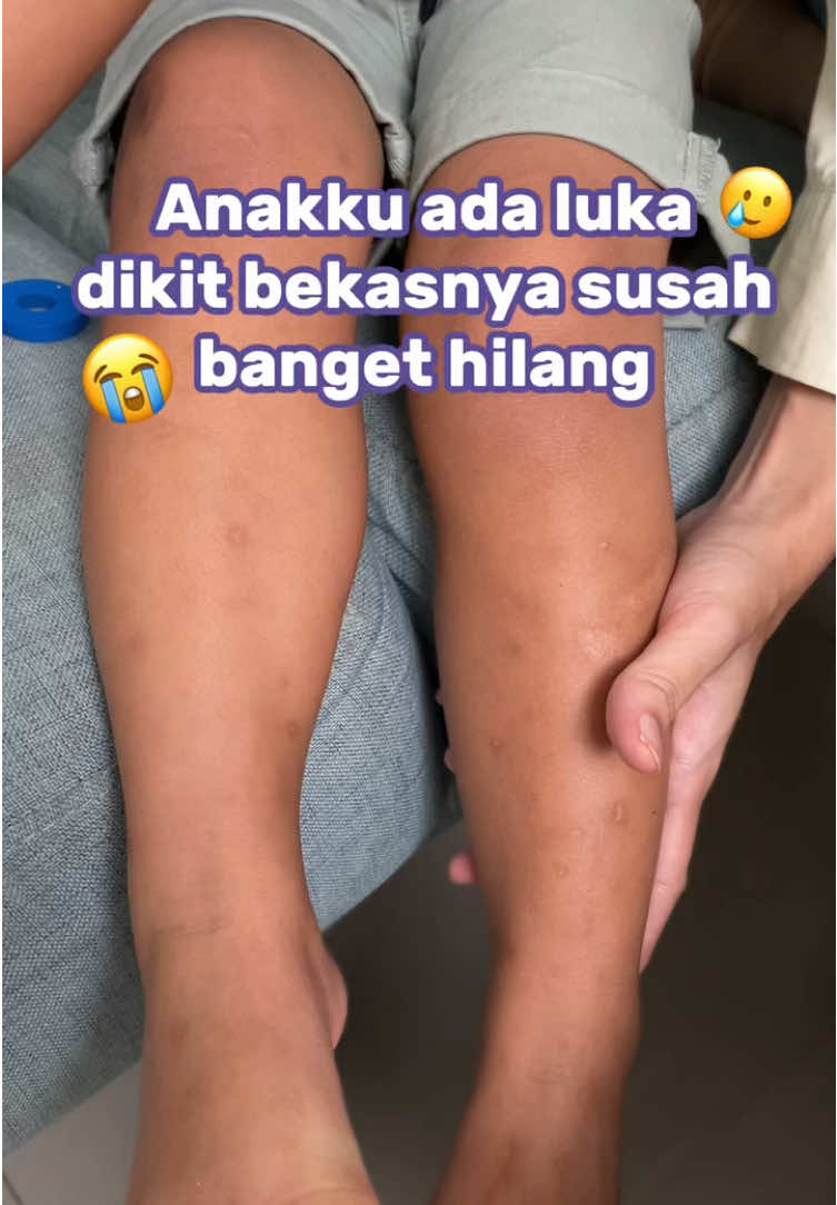 Anakku tipe yang ada bekas luka pasti susah banget hilang🥲 Untung aja aku nemuin Soothing Baby Crème, skincare yang direkomendasiin Dokshin😍 Alhamdulillah sekarang bekas lukanya makin memudar🥰✨ Buat bunda punya permasalahan yang sama bisa cobain Soothing Baby Crème, klik keranjang kuning👇🏻 #skincareanakaktif #skincareanak #rekomendasiskincareanak #brandofthemonth #purela 