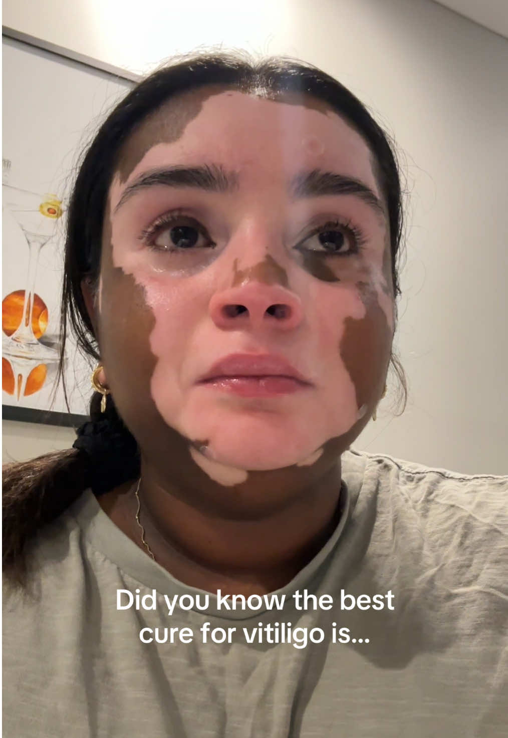 Sending this to younger me ♥️ #vitiligo #skin #selflove #acceptance #SelfCare #confidence #girls 