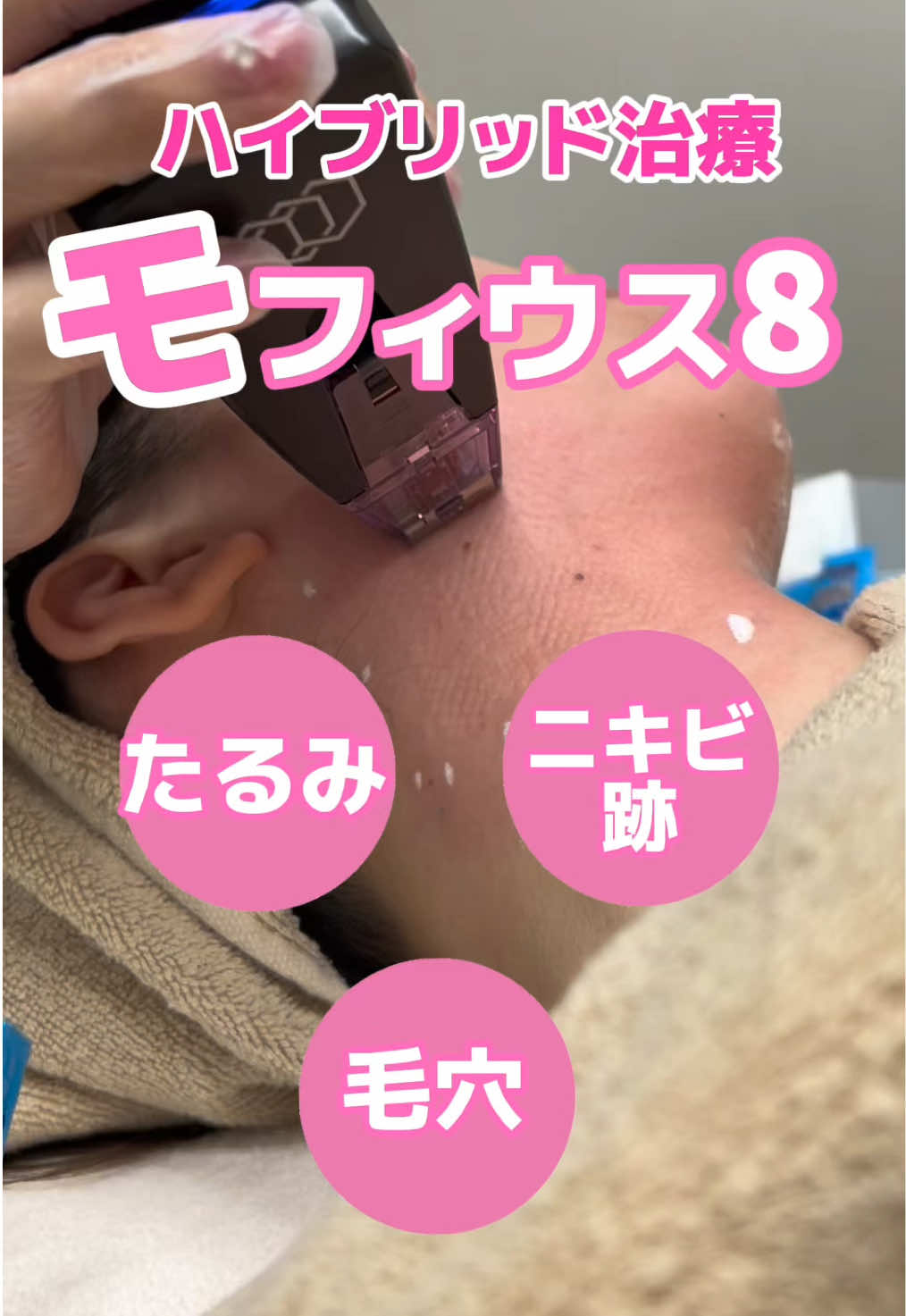 #モフィウス8#美容医療 #たるみ改善 #美肌治療 #エイジングケア #morpheus8 #morpheus #morpheus8treatment #filler #botox #injections #fyp #foryou #viral#おすすめ 