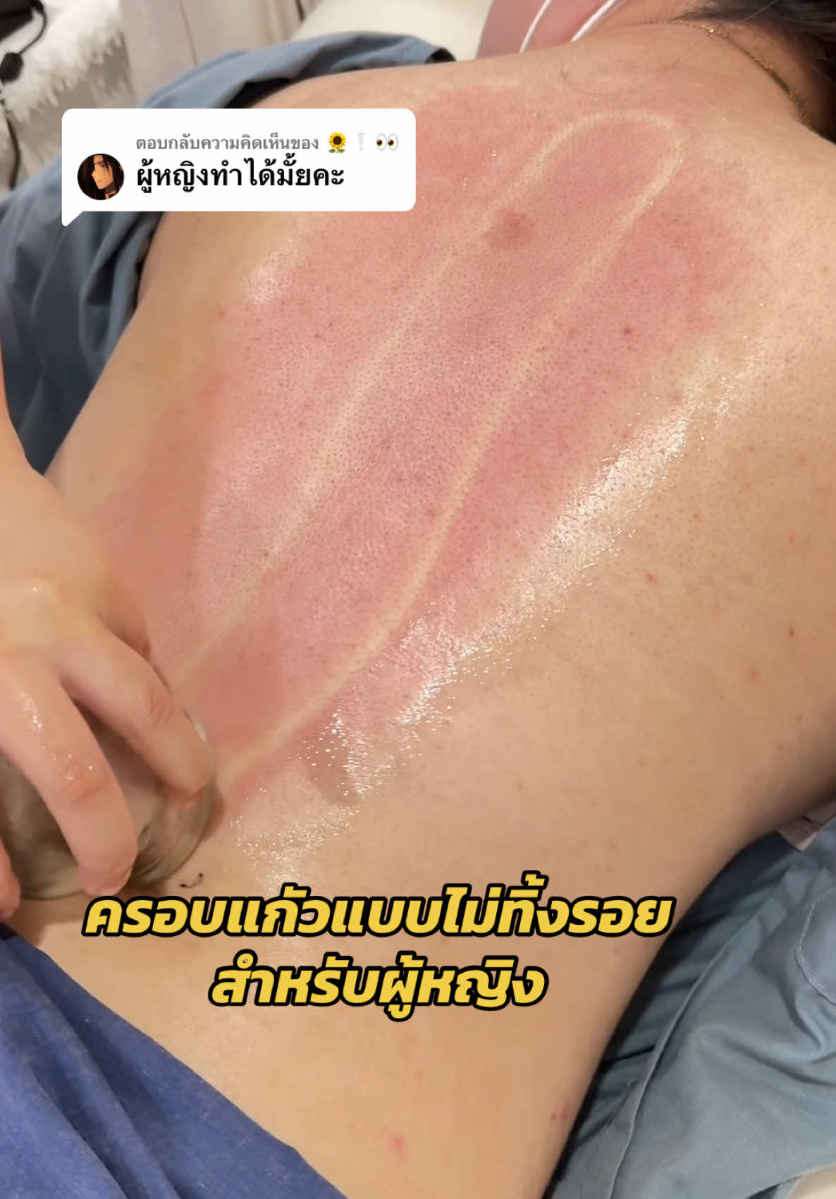 ตอบกลับ @🌻❕👀 ผู้หญิงก็สามารถครอบแก้วแบบไม่ทิ้งรอยได้เช่นกันค่า #ครอบแก้ว #ครอบแก้วรักษาอาการปวด #ปวดคอบ่าไหล่ #ออฟฟิศซินโดรม #ปวดหลัง #cupping #cuppingtherapy #ปวดเอว #ฟาจินคลินิก #ครอบแก้วอ่อนนุช 