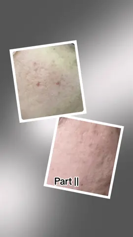 Halfway through one scar therapy bar, the texture and scarring have already improved! After completing the whole bar, there should be even greater results. #unearthmalee #ecofriendlymakeup #acneskin 