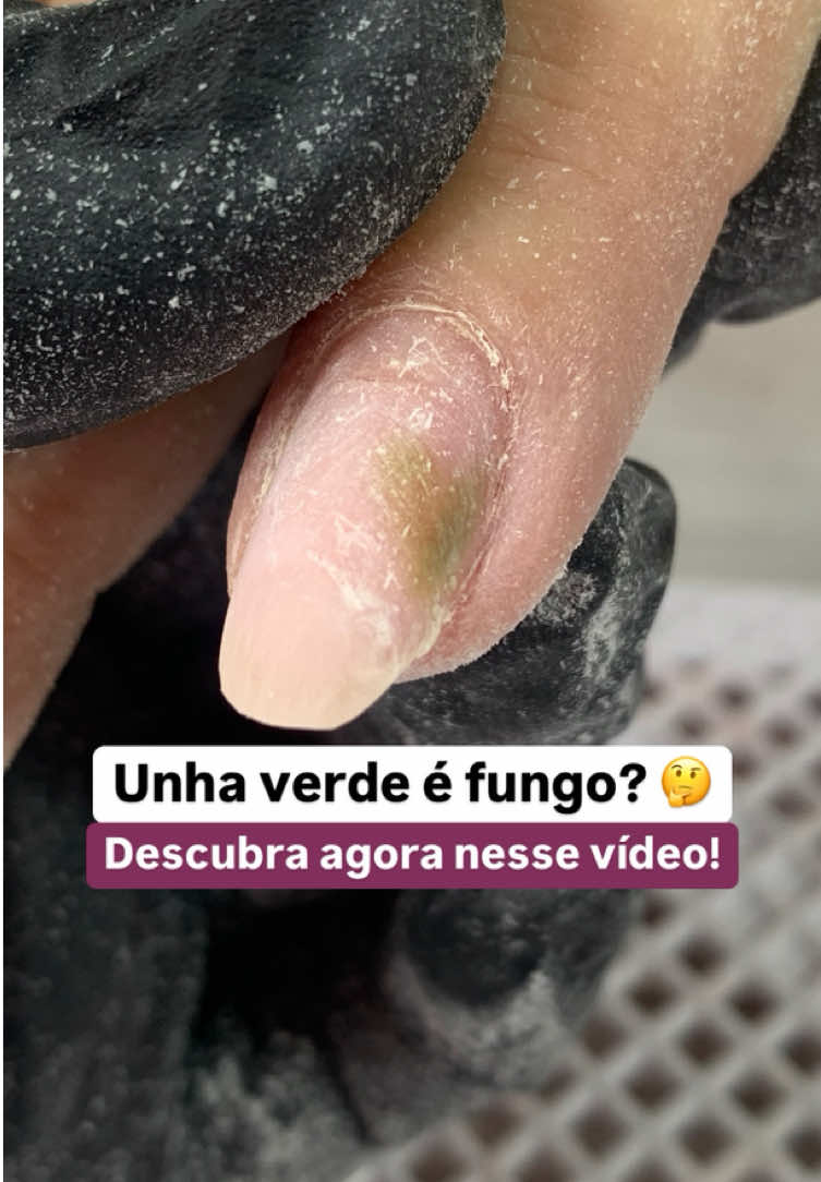Nail Designer, será que a unha verde é fungo? Vou te contar o que é e como resolver esse problema em mesa! ⠀ ➡️ A síndrome das unhas esverdeadas é causada pela bactéria pseudomonas. Ela se instala quando há um espaço entre a unha natural e o alongamento. ⠀ Ou seja, se você recebe uma unha assim em mesa, NÃO É FUNGO! ⠀ 🤔 POR QUE ACONTECE? ⠀ - Descolamento da unha (onicólise);⠀ - Exposição constante a umidade sem o uso de luvas;⠀ - Alongamentos mal feitos, deixando espaço para a entrega de água. ⠀ ⚠️ No vídeo eu deixei o que eu oriento e qual procedimento faço quando recebo esse probleminha em mesa. ⠀ #alongamentodeunhas #naildesigner #alongamentodeunhas 