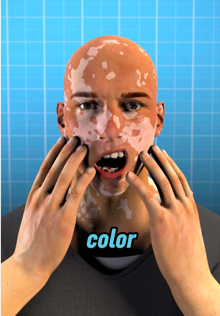 Vitiligo happens when the pigment cells in your skin—called melanocytes—disappear without warning. It’s often your own immune system attacking them. Sometimes it’s genetic. Other times, it’s triggered by stress or skin trauma. #vitiligoawareness #skinhealth #autoimmune #melaninmatters #skinpositivity #vitiligojourney #skindiversity #dermatology #selflove #beautyinallcolors