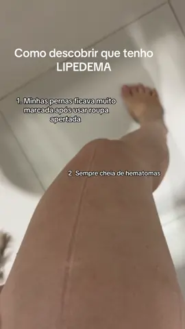 Pra quem não sabe o lipedema é uma condição médica crônica caracterizada pelo acúmulo anormal de gordura em membros inferiores, principalmente pernas e quadris, e, por vezes, nos braços. Afeta predominantemente mulheres e se manifesta com dores, sensibilidade ao toque, inchaço e hematomas frequentes #fy #lipedema #lipedemabrasil #lipedema 