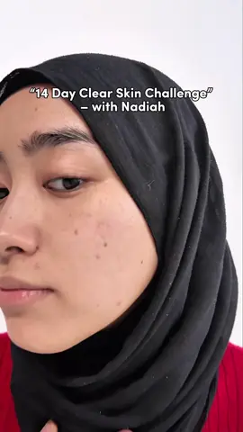 From breakouts to brighter days 😭 My 14-day glow-up with Dr. Belmeur Pink Booster Serum starts now — Grab the 5.5 deal on THE FACE SHOP TikTok Shop and get that clear, healthy skin @THE FACE SHOP MY ! #pinkskinbooster #kbeauty #darkspot #darkspottherapy #postacnemark #GoldenRecipe #tfsmy #thefaceshopmalaysia