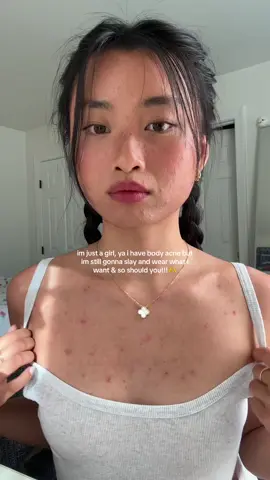 weekly reminder that you are beautiful despite your acne!! #acne #acneskin #acnepositivity #acnejourney 