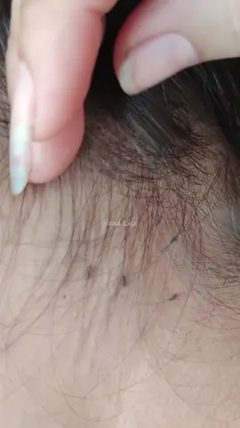 Picking nits and remove lice on the head 408 #liceremoval #headliceremoval #licetreatment #howtoremovelice #licetreatment #howtoremoveheadlice #headlicetreatment #licetok #lice #getridoflicepermanently #lice #howtoremovelicefromhair #nitfreeterminator #howtogetridoflicenaturally #howtoremoveliceeggsfromhair #licecenterswi #howtogetridoflicepermanently #science #biology #headlice #howtogetridofheadlicepermanently #howtogetridoflicefast #tiktokpartner