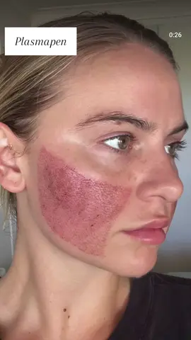⚜️ Plasma Pen ⚜️ #skins #skincare #straffehaut #akne #plasma #plasmapen #plasmafibroblast #plasmatreatment #fibroblast #plasmalift #fyp #foryou #foryoupage #viral_video 
