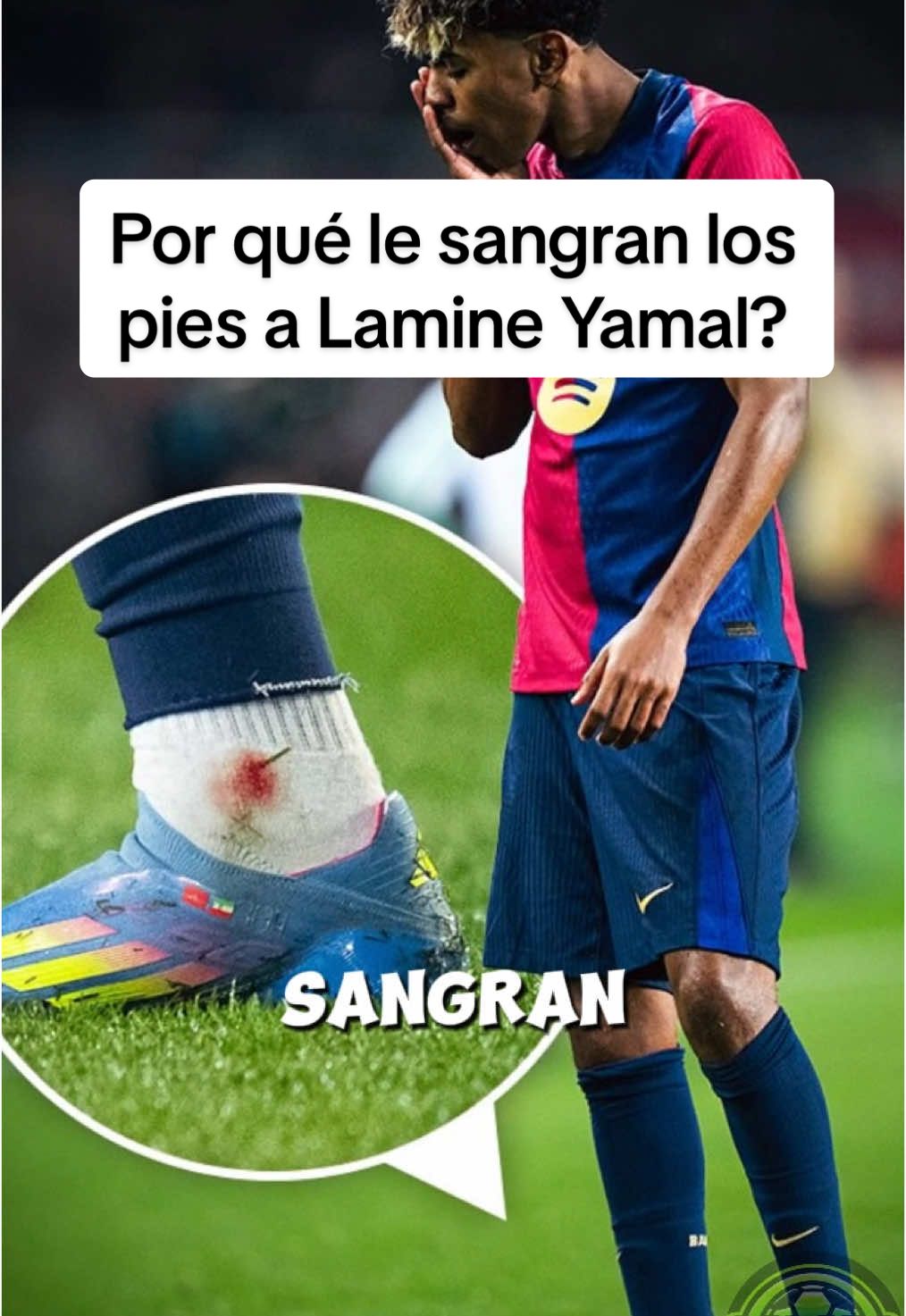 Por qué Lamine Yamal le duelen los pies después de cada partido #lamineyamal #yamal #barcelona #barcelonavsintermilan #footballtiktok #liga #parati 