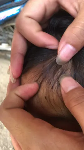 #😱#omg #lice #liceremoval #treanding #😱😱 
