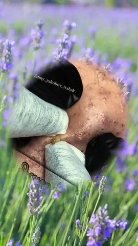 #foryou #squeezeyuk #acne #satisfyingvideo #relax 
